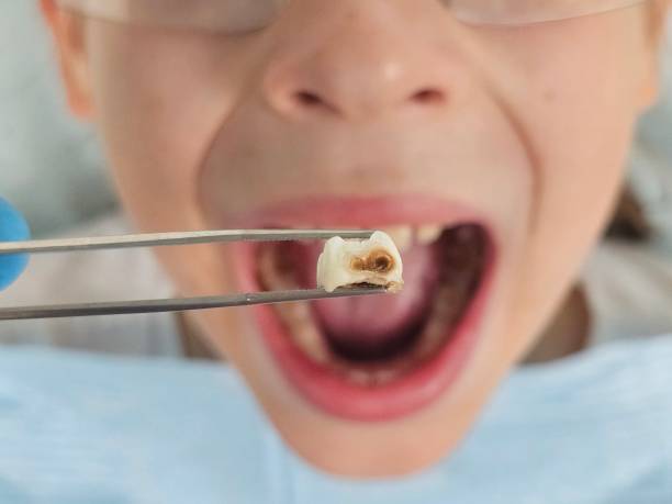 Best Urgent Care for Lost Fillings or Crowns in Campbellsville, KY